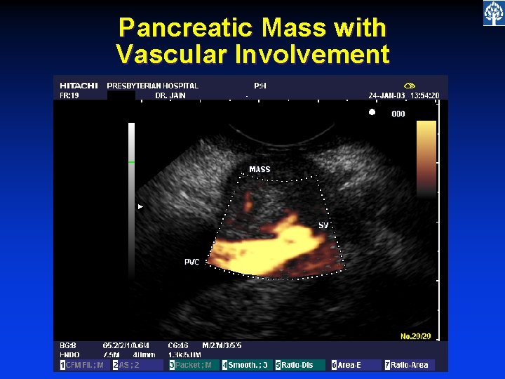 Pancreatic Mass with Vascular Involvement 