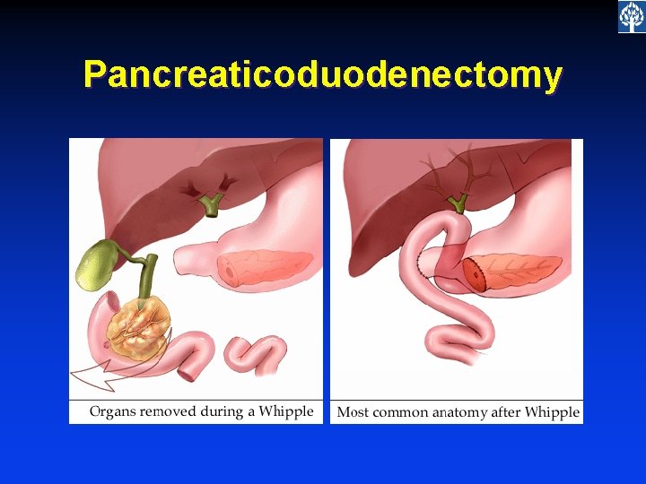 Pancreaticoduodenectomy 