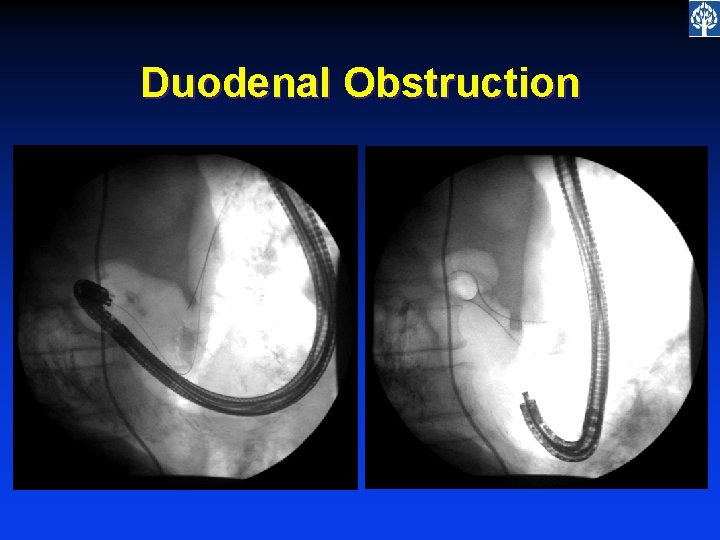 Duodenal Obstruction 