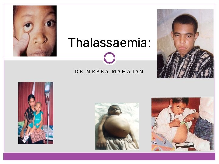 Thalassaemia: DR MEERA MAHAJAN 