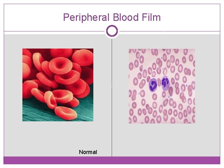 Peripheral Blood Film Normal 