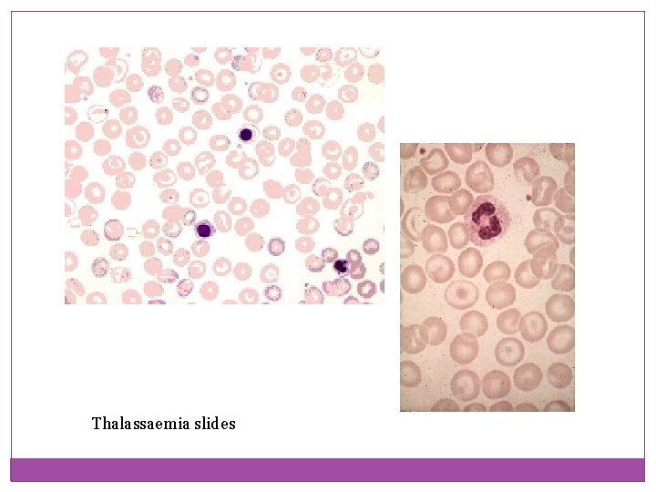 Thalassaemia slides 