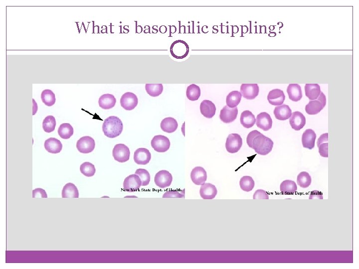 What is basophilic stippling? 