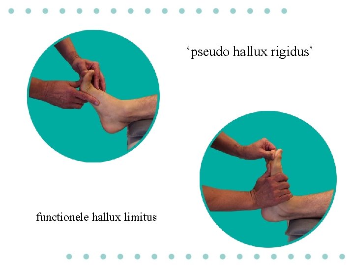 ‘pseudo hallux rigidus’ functionele hallux limitus 