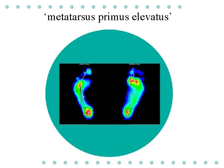 ‘metatarsus primus elevatus’ 