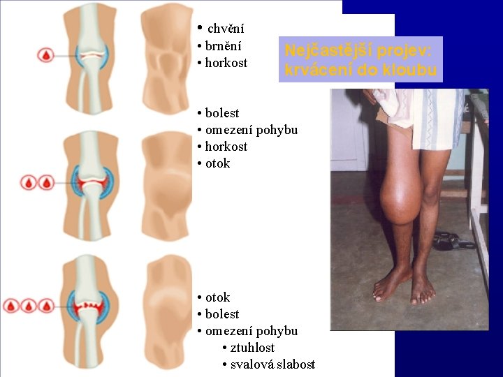  • chvění • brnění • horkost Nejčastější projev: krvácení do kloubu • bolest