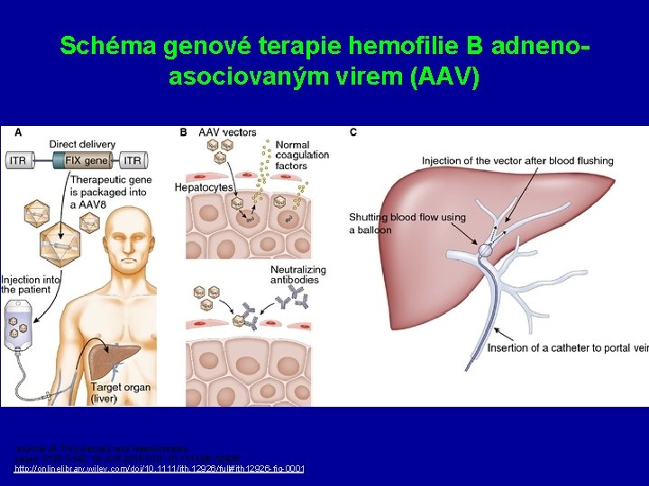 Schéma genové terapie hemofilie B adnenoasociovaným virem (AAV) Journal of Thrombosis and Haemostasis pages