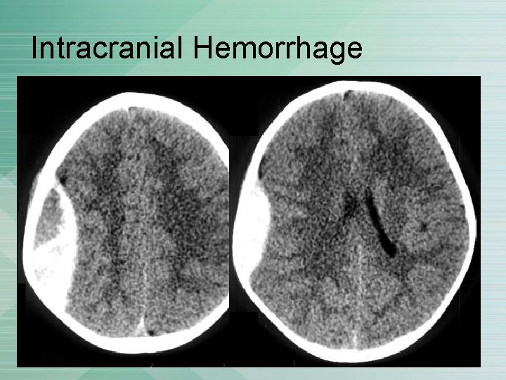 Intracranial Hemorrhage 