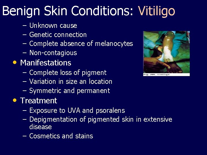Benign Skin Conditions: Vitiligo – – Unknown cause Genetic connection Complete absence of melanocytes