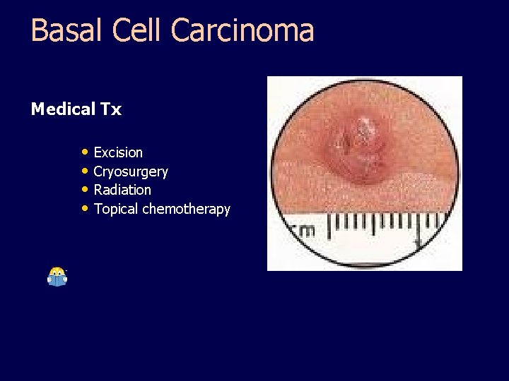 Basal Cell Carcinoma Medical Tx • Excision • Cryosurgery • Radiation • Topical chemotherapy