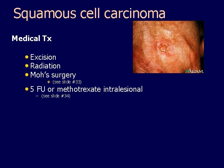 Squamous cell carcinoma Medical Tx • Excision • Radiation • Moh’s surgery v (see