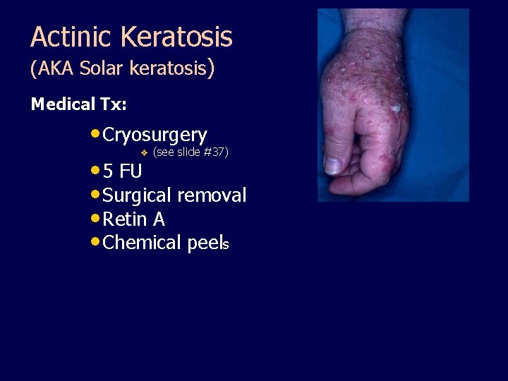 Actinic Keratosis (AKA Solar keratosis) Medical Tx: • Cryosurgery v (see slide #37) •