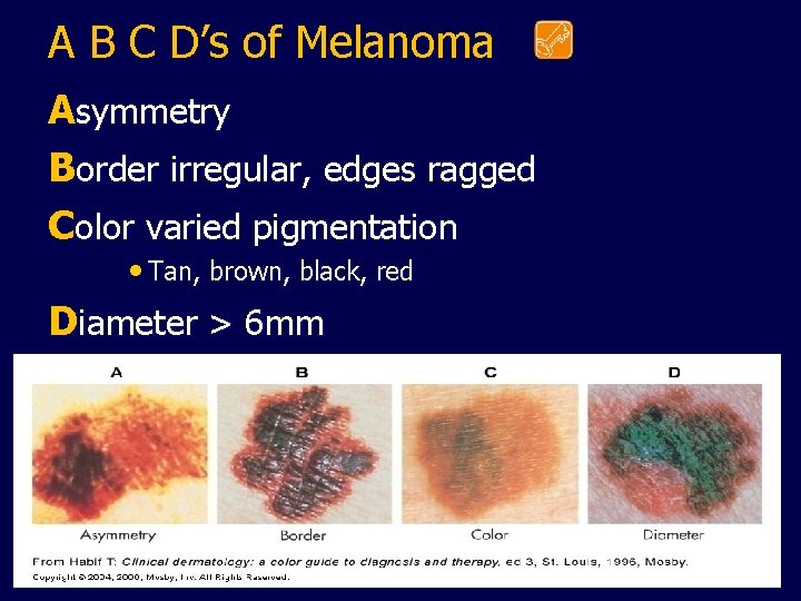 A B C D’s of Melanoma Asymmetry Border irregular, edges ragged Color varied pigmentation