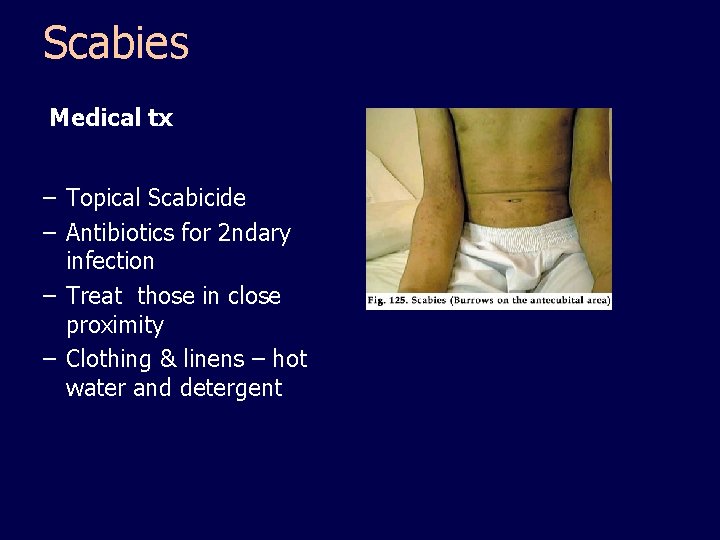 Scabies Medical tx – Topical Scabicide – Antibiotics for 2 ndary infection – Treat