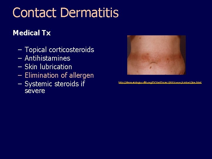 Contact Dermatitis Medical Tx – – – Topical corticosteroids Antihistamines Skin lubrication Elimination of