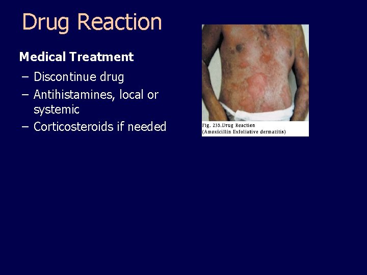 Drug Reaction Medical Treatment – Discontinue drug – Antihistamines, local or systemic – Corticosteroids