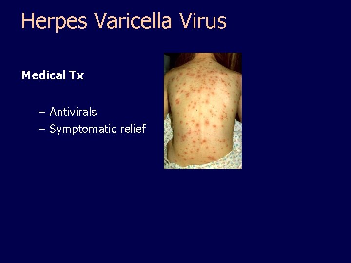 Herpes Varicella Virus Medical Tx – Antivirals – Symptomatic relief 