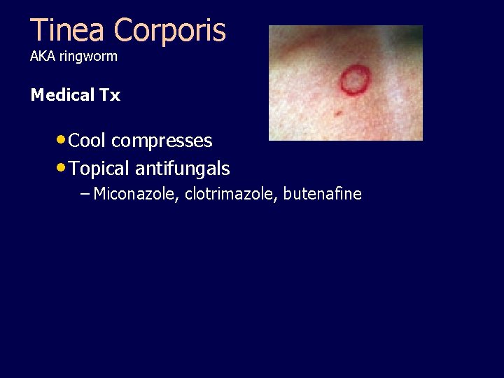 Tinea Corporis AKA ringworm Medical Tx • Cool compresses • Topical antifungals – Miconazole,