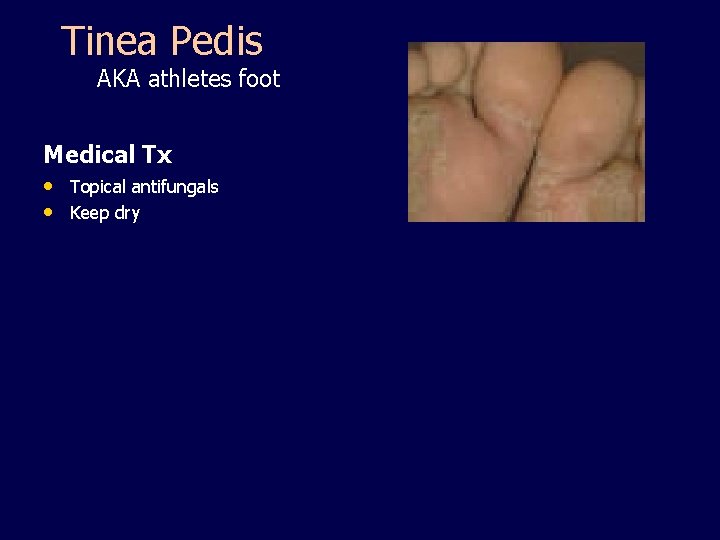 Tinea Pedis AKA athletes foot Medical Tx • Topical antifungals • Keep dry 