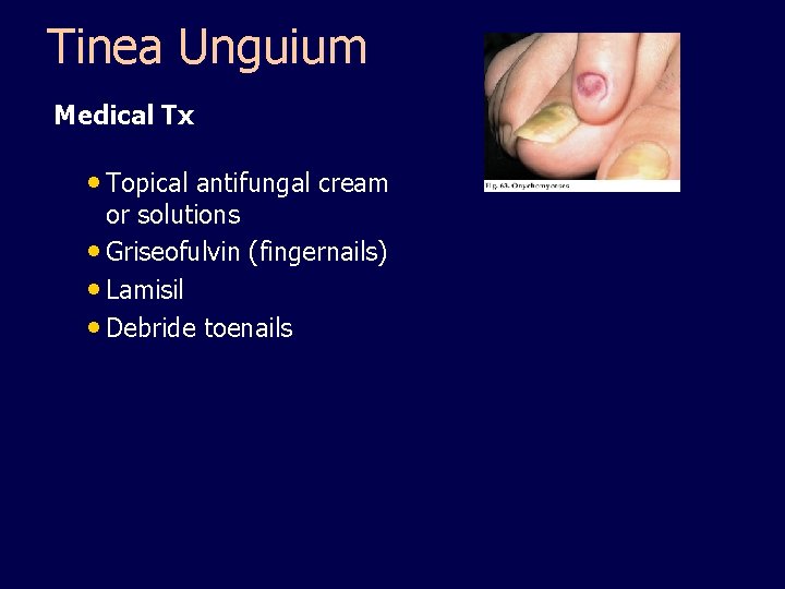 Tinea Unguium Medical Tx • Topical antifungal cream or solutions • Griseofulvin (fingernails) •