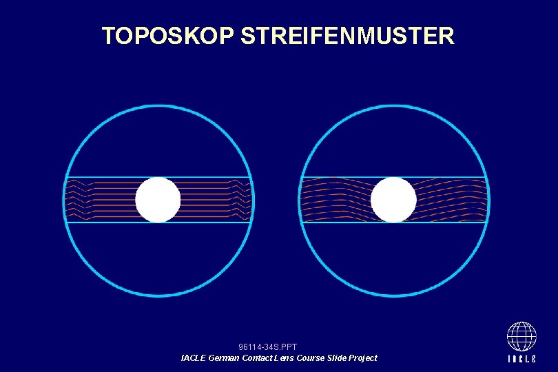 TOPOSKOP STREIFENMUSTER 96114 -34 S. PPT IACLE German Contact Lens Course Slide Project 