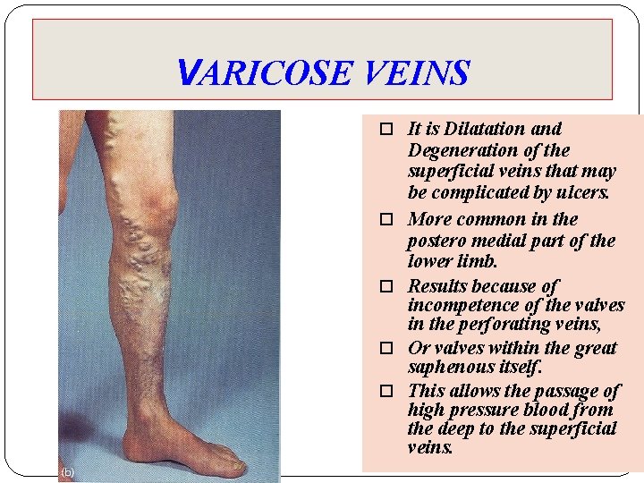 VARICOSE VEINS It is Dilatation and Degeneration of the superficial veins that may be