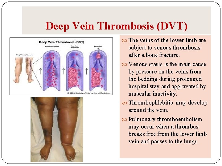 Deep Vein Thrombosis (DVT) The veins of the lower limb are subject to venous