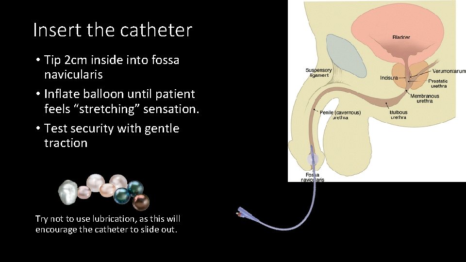 Insert the catheter • Tip 2 cm inside into fossa navicularis • Inflate balloon