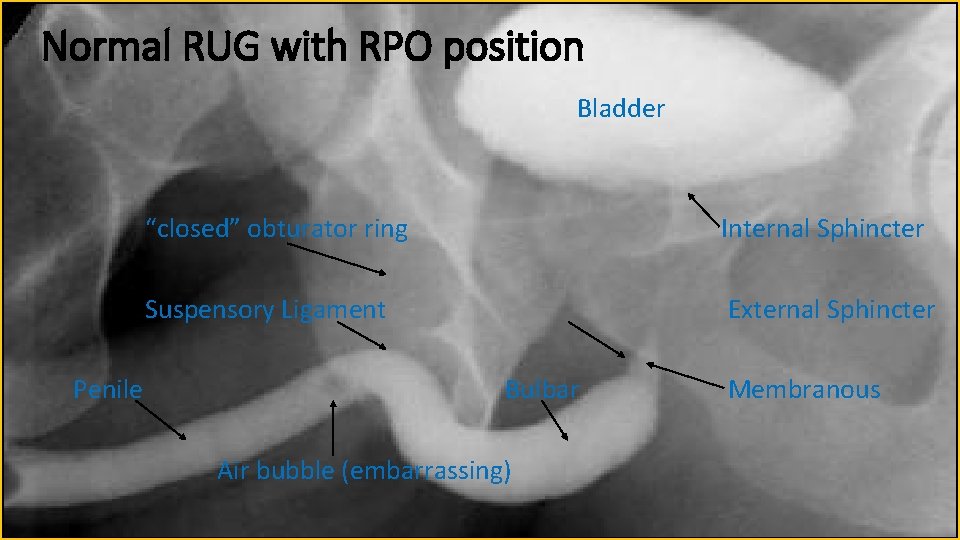 Normal RUG with RPO position Bladder Penile “closed” obturator ring Internal Sphincter Suspensory Ligament