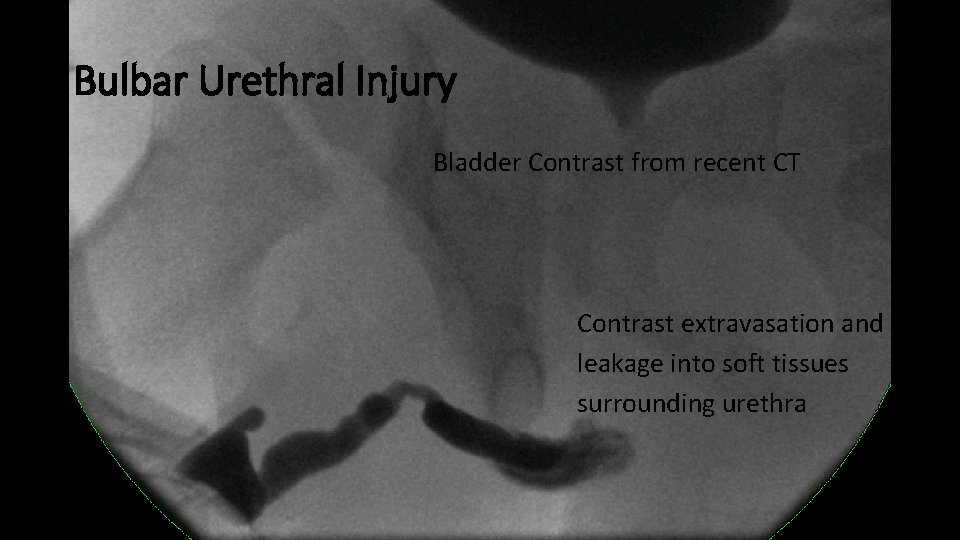Bulbar Urethral Injury Bladder Contrast from recent CT Contrast extravasation and leakage into soft