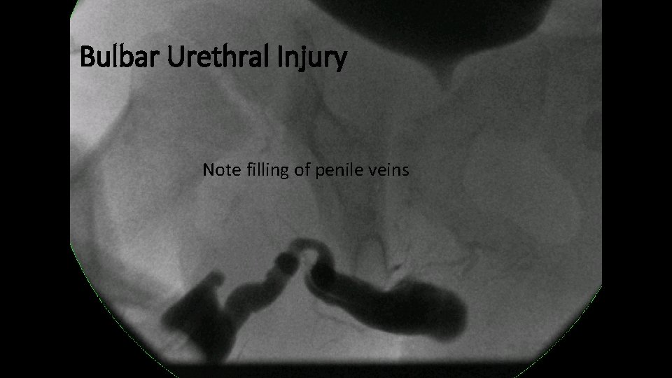 Bulbar Urethral Injury Note filling of penile veins 