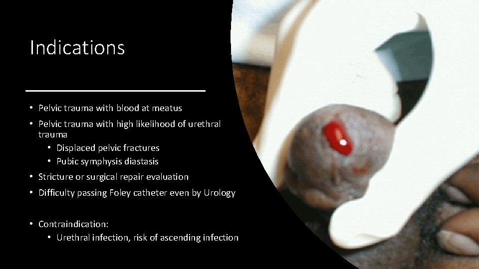 Indications • Pelvic trauma with blood at meatus • Pelvic trauma with high likelihood