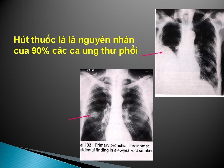 Hút thuốc lá là nguyên nhân của 90% các ca ung thư phổi 