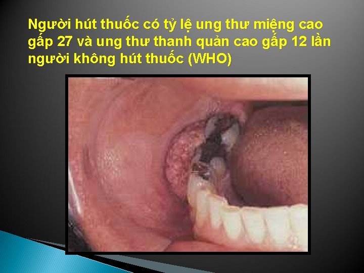 Người hút thuốc có tỷ lệ ung thư miệng cao gấp 27 và ung