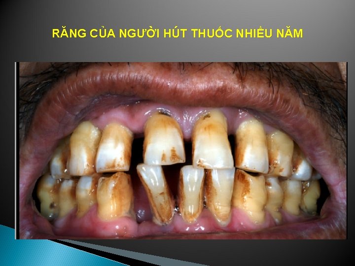 RĂNG CỦA NGƯỜI HÚT THUỐC NHIỀU NĂM 