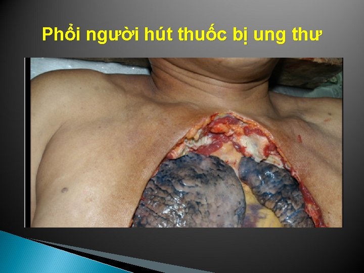 Phổi người hút thuốc bị ung thư 