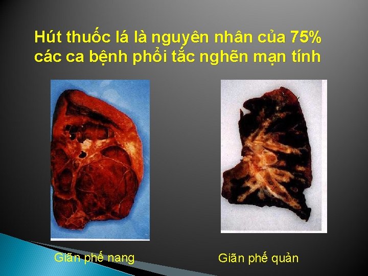 Hút thuốc lá là nguyên nhân của 75% các ca bệnh phổi tắc nghẽn