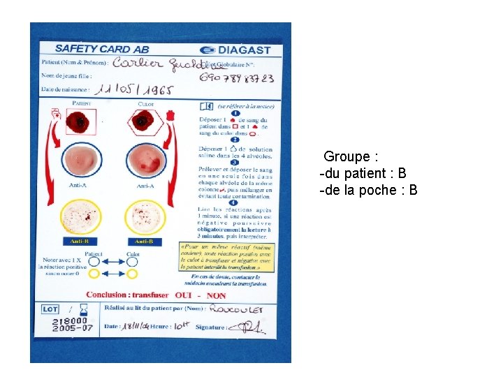  Groupe : -du patient : B -de la poche : B 