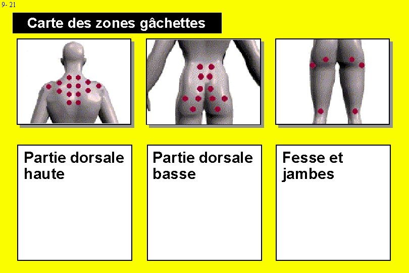 9 - 21 Carte des zones gâchettes Partie dorsale haute Partie dorsale basse Fesse