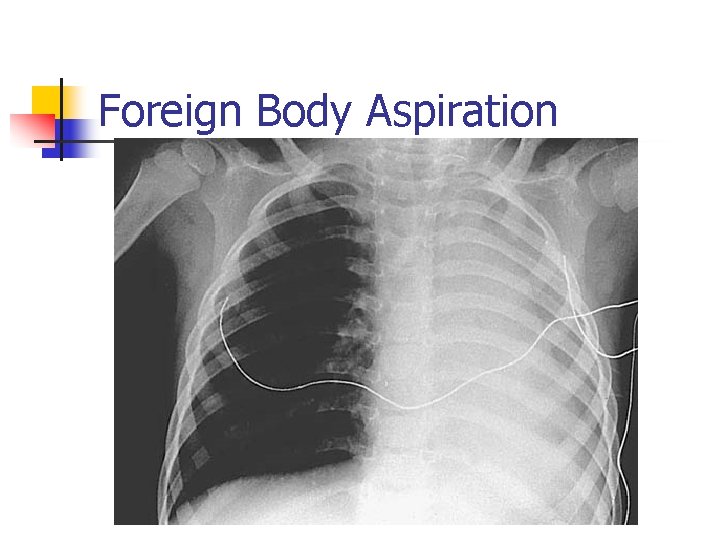 Foreign Body Aspiration 