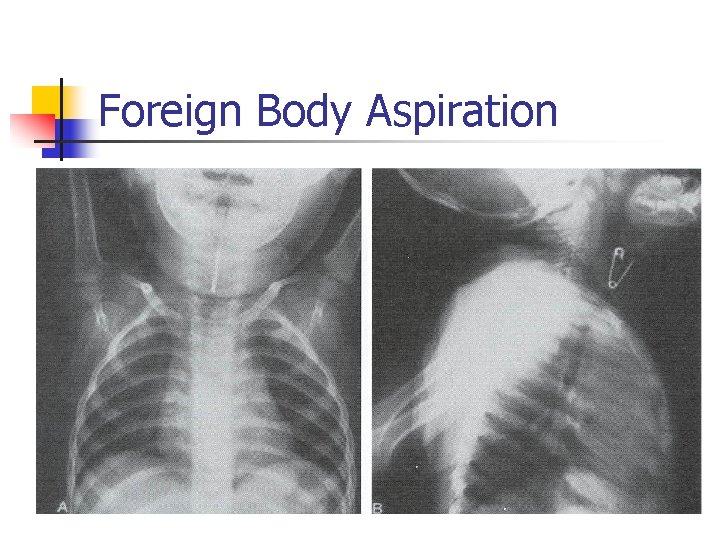 Foreign Body Aspiration 