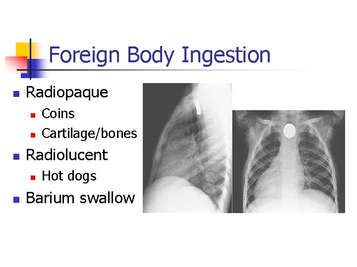 Foreign Body Ingestion n Radiopaque n n n Radiolucent n n Coins Cartilage/bones Hot