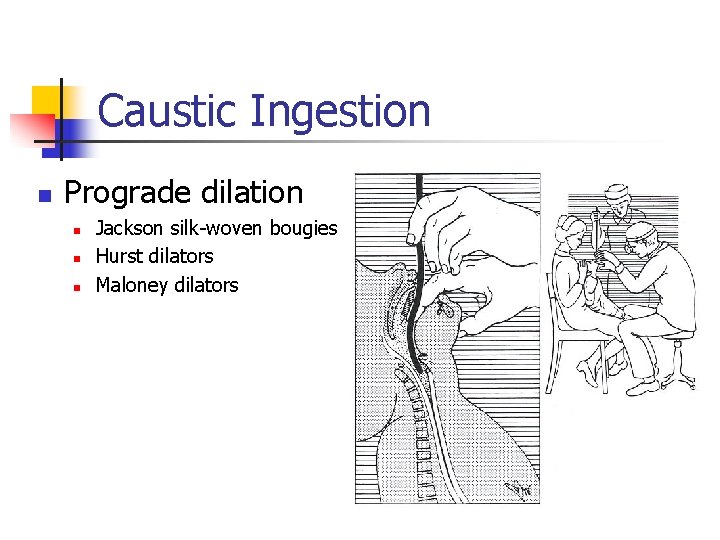 Caustic Ingestion n Prograde dilation n Jackson silk-woven bougies Hurst dilators Maloney dilators 