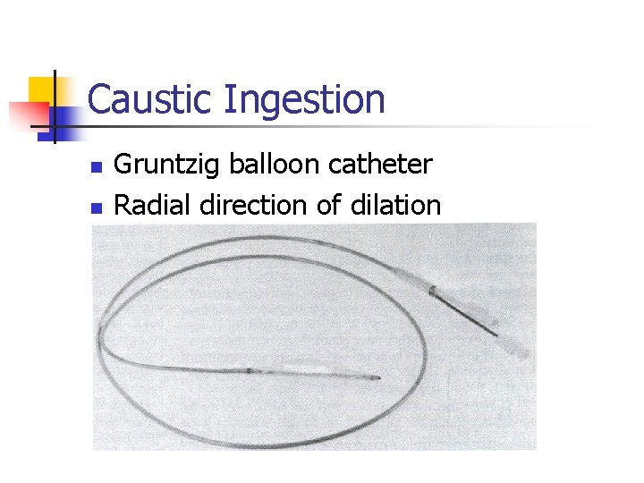 Caustic Ingestion n n Gruntzig balloon catheter Radial direction of dilation 