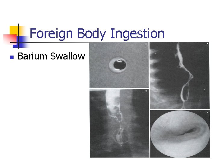 Foreign Body Ingestion n Barium Swallow 