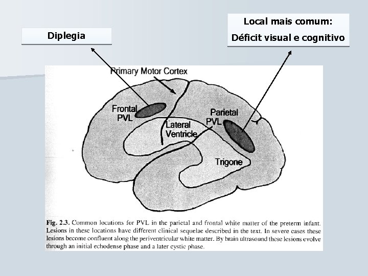 Local mais comum: Diplegia Déficit visual e cognitivo 