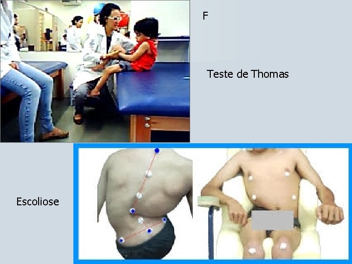 F Teste de Thomas Escoliose 