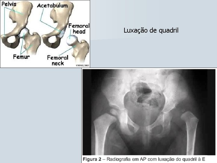 Luxação de quadril 