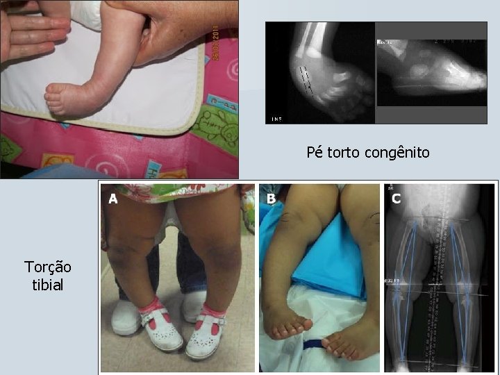 Pé torto congênito Torção tibial 