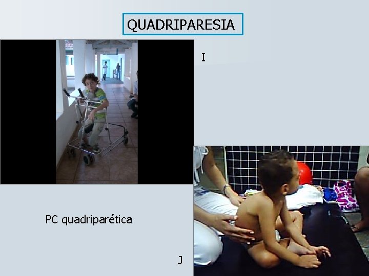 QUADRIPARESIA I PC quadriparética J 